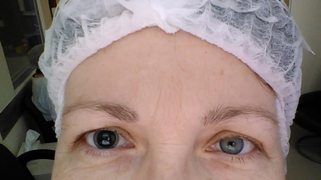 Rozkapané oči před operací