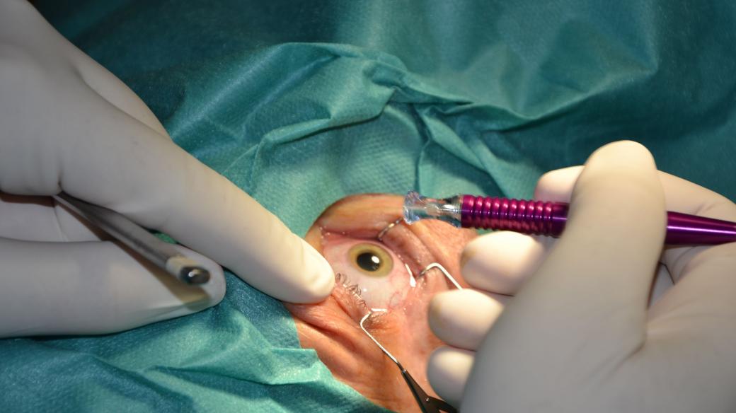 Lékaři v ústecké nemocnici mají jako první v Česku nový laser na operace zeleného zákalu