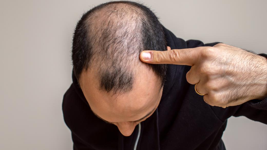 Ubývání vlasů některé muže hodně trápí