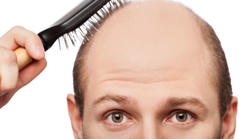 Alopecie, tedy plešatění, se týká především mužů