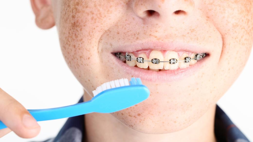 Správná a častá zubní hygiena je při používání rovnátek klíčová