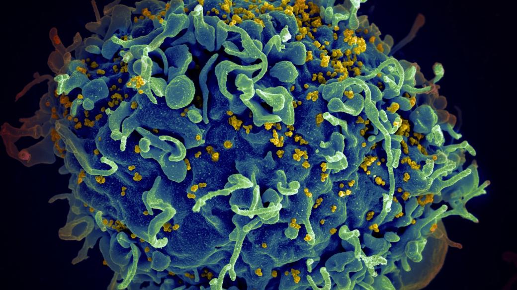 Buňka napadená virem HIV (označen žlutě)