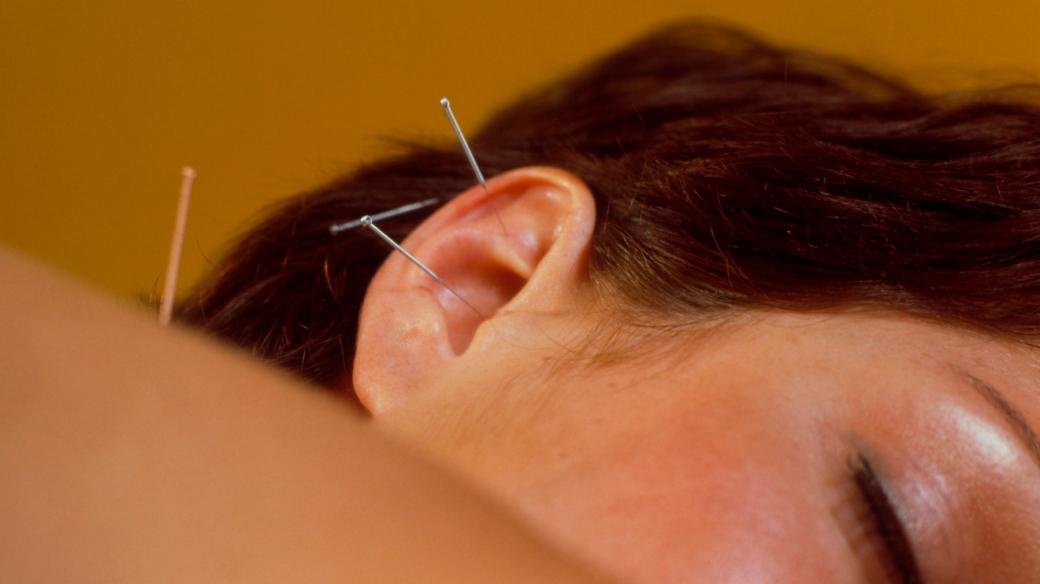 Akupunktura (ilustrační foto)
