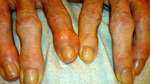 Artróza - deformity kloubů na prstech (Heberdenovy uzly)