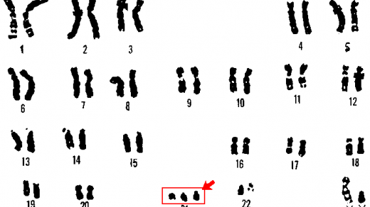 Chromozomy člověka s Downovým syndromem