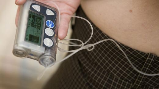 Na léčbu diabetes mellitus se už běžně používají inzulínové pumpy