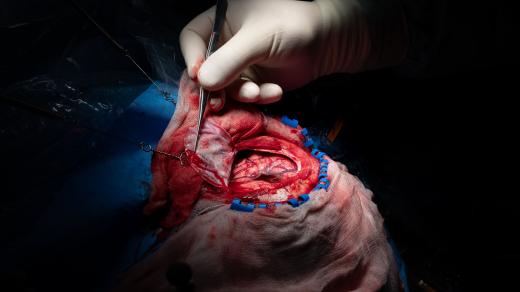 Operace mozku, Neurochirurgická klinika FN HK