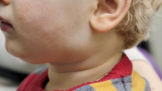 Příušnice, nemoc, dítě, vyrážka (ilustrační foto)