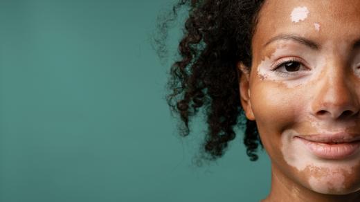 Vitiligo je porucha pigmentace kůže