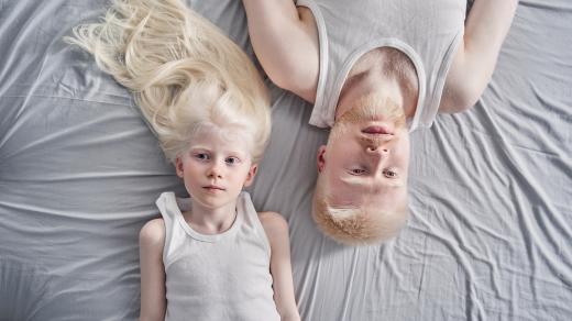 Albinismus je dědičná porucha tvorby barviva melaninu