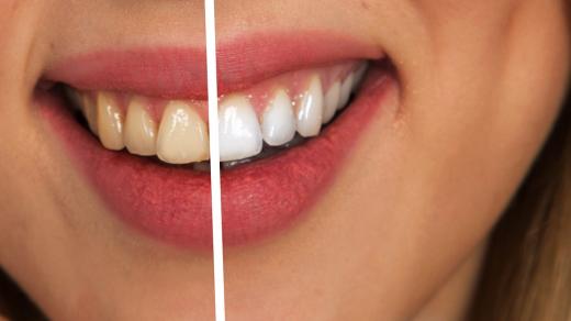 Moderní metodou, jak si udržet krásný úsměv, je bělení zubů
