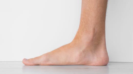 Ploché nohy, chodidlo, (ilustrační foto)