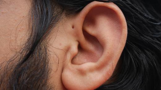 Preauricular sinus je drobná dírka na uchu