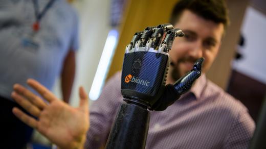 Bionická ruka dává pacientům zcela nové možnosti