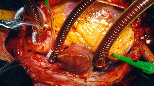 Operace srdce