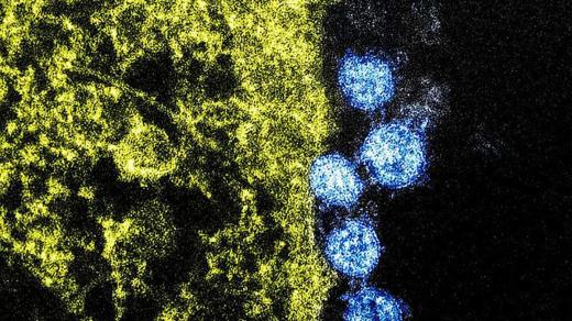 Koronavirus SARS-CoV-2 způsobující onemocnění COVID-19 pod elekronovým mikroskopem.